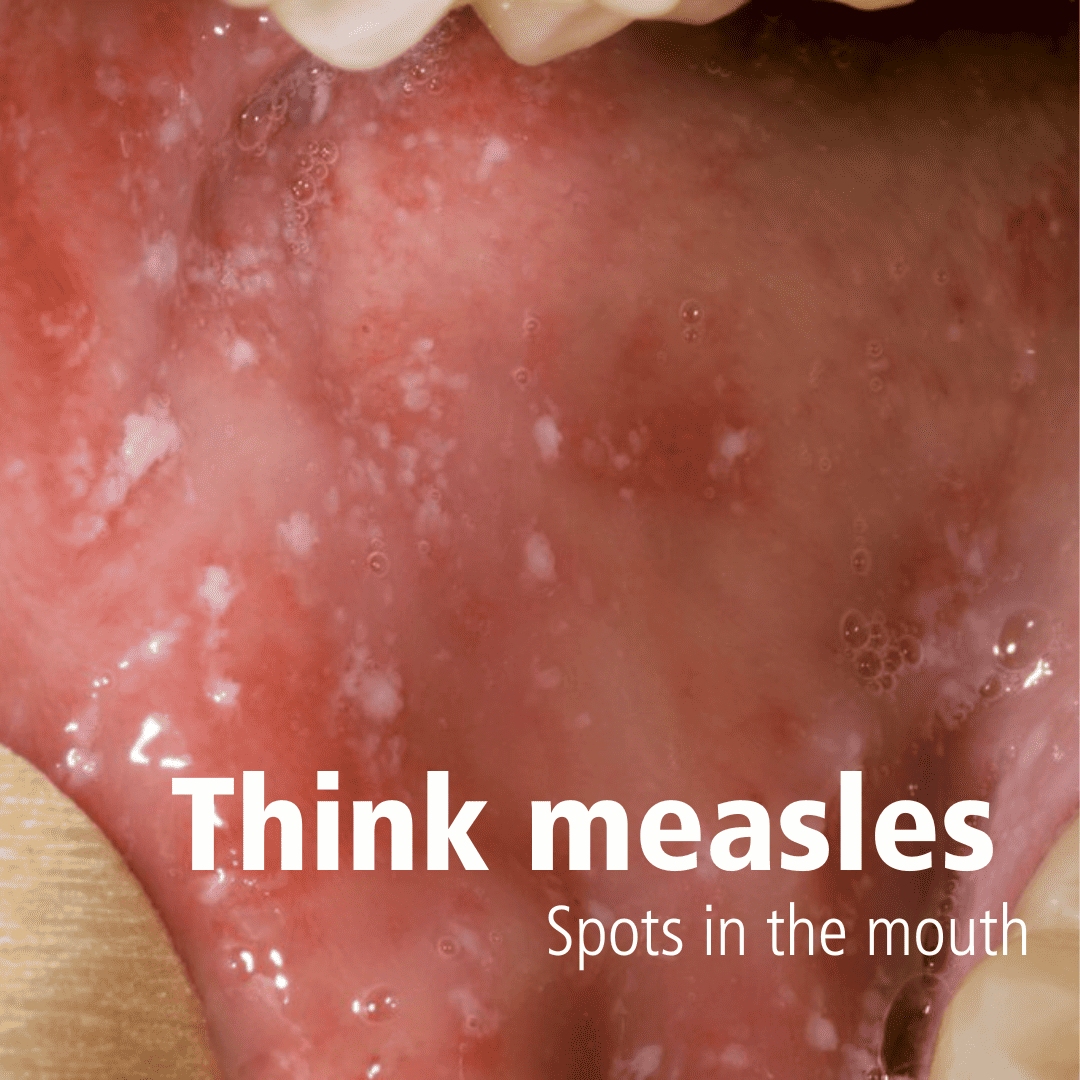 Think measles! - Birmingham and Solihull Mental Health NHS Foundation Trust