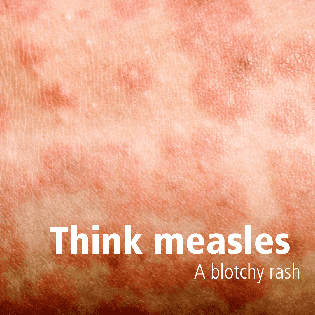 Think measles birmingham and solihull mental health nhs foundation trust